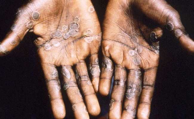 MONKEY POX IN TURKEY