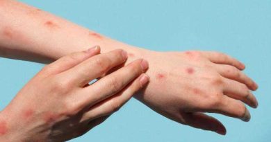 MONKEY POX DISEASE 190824