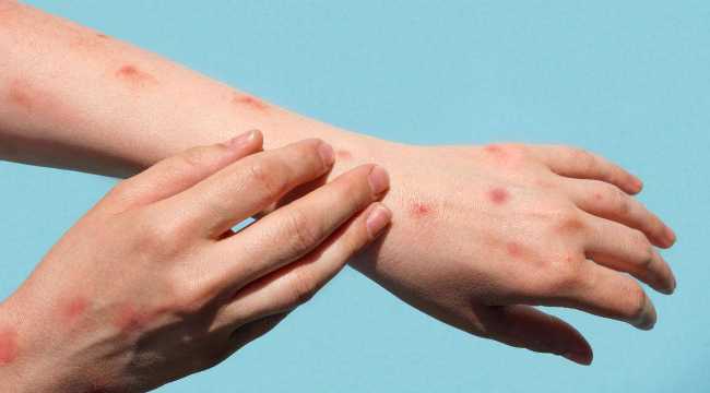 MONKEY POX DISEASE 190824