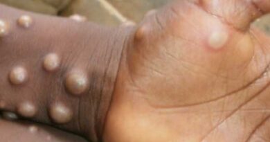 MONKEY POX VIRUS