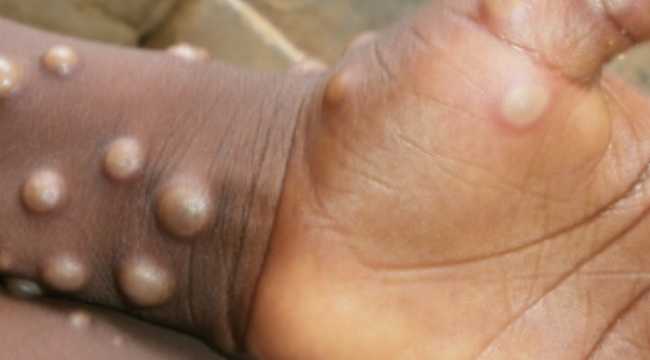 MONKEY POX VIRUS